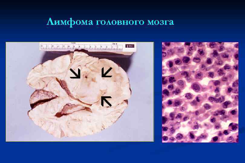 Лимфома головного мозга 