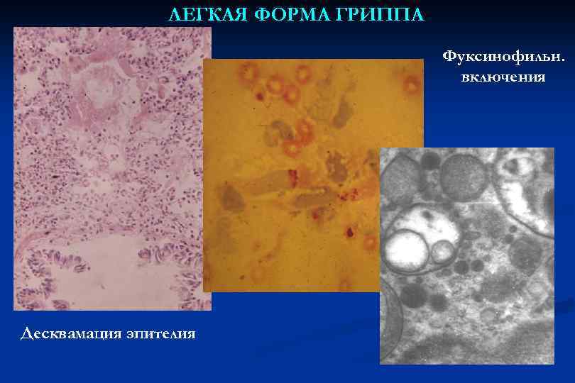 ЛЕГКАЯ ФОРМА ГРИППА Фуксинофильн. включения Десквамация эпителия 