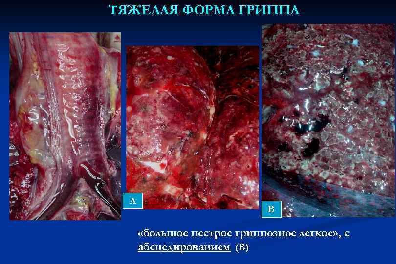 ТЯЖЕЛАЯ ФОРМА ГРИППА А В «большое пестрое гриппозное легкое» , с абсцедированием (В) 