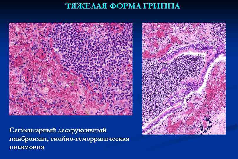 ТЯЖЕЛАЯ ФОРМА ГРИППА Сегментарный деструктивный панбронхит, гнойно-геморрагическая пневмония 
