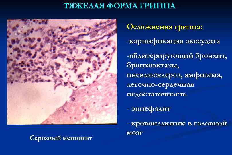 ТЯЖЕЛАЯ ФОРМА ГРИППА Осложнения гриппа: -карнификация экссудата -облитерирующий бронхит, бронхоэктазы, пневмосклероз, эмфизема, легочно-сердечная недостаточность