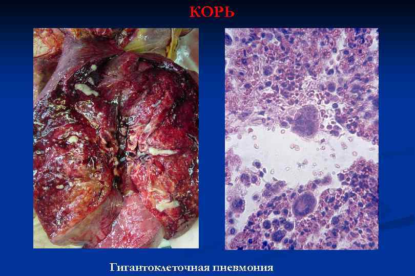 КОРЬ Гигантоклеточная пневмония 