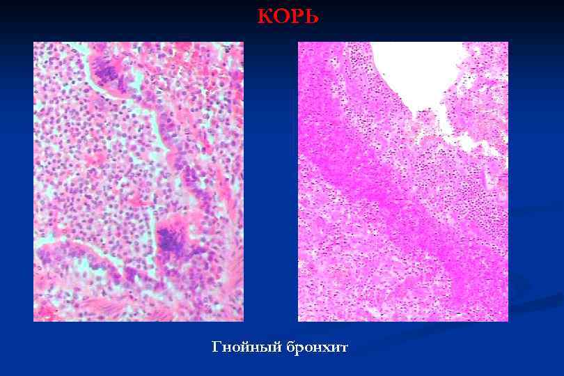 КОРЬ Гнойный бронхит 
