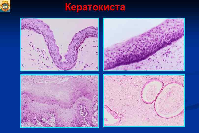 Микропрепарат стенка радикулярной кисты