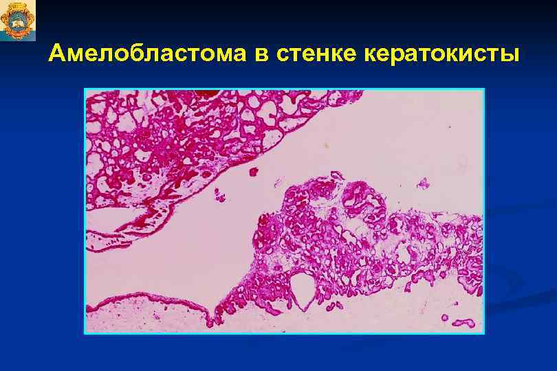 Презентация одонтогенные опухоли