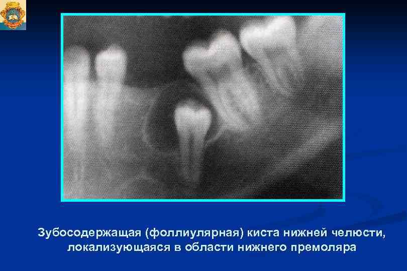 Одонтогенная киста фото