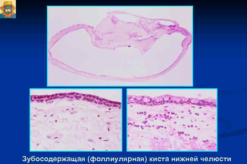 Зубосодержащая (фоллиулярная) киста нижней челюсти 