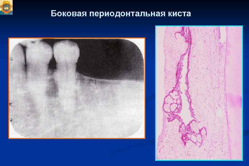 Одонтогенная киста фото