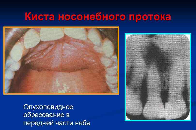 Киста носонебного протока Опухолевидное образование в передней части неба 