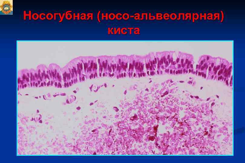 Одонтогенная киста фото