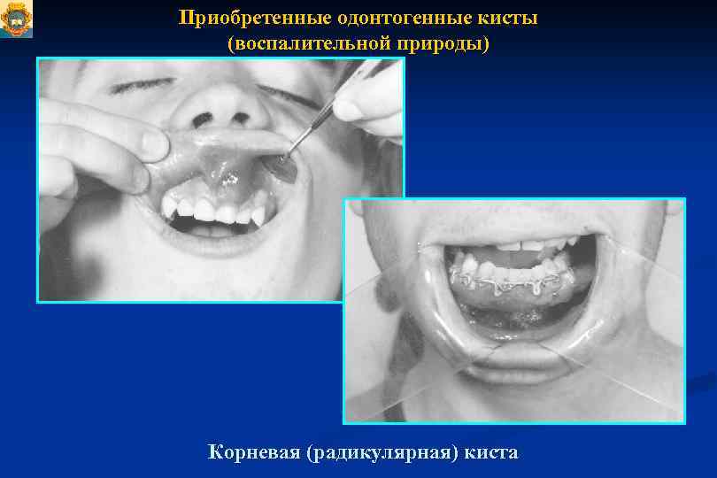 Приобретенные одонтогенные кисты (воспалительной природы) Корневая (радикулярная) киста 