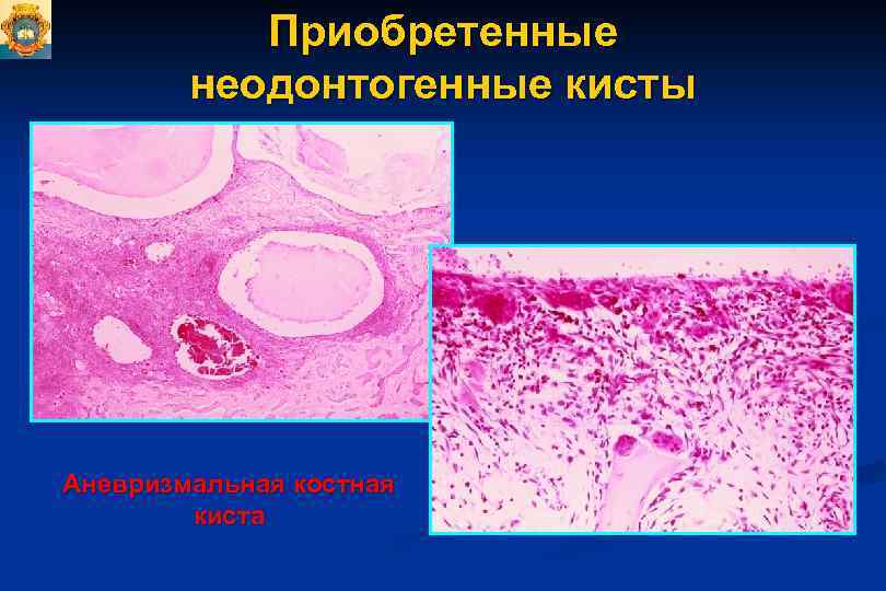 Одонтогенная киста фото