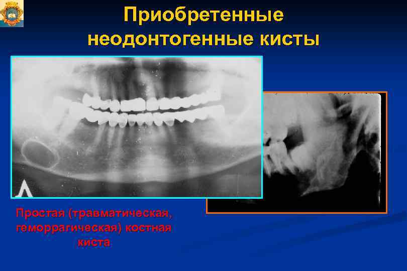 Приобретенные неодонтогенные кисты Простая (травматическая, геморрагическая) костная киста 
