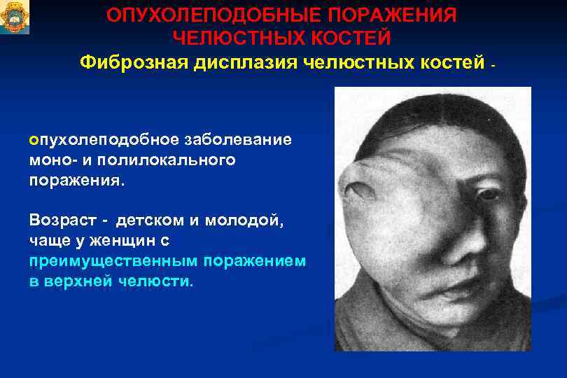ОПУХОЛЕПОДОБНЫЕ ПОРАЖЕНИЯ ЧЕЛЮСТНЫХ КОСТЕЙ Фиброзная дисплазия челюстных костей - опухолеподобное заболевание моно- и полилокального