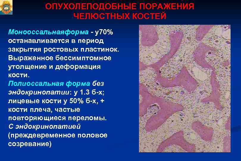 Доброкачественные одонтогенные опухоли презентация