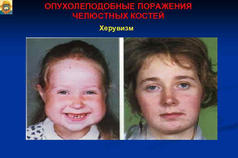 ОПУХОЛЕПОДОБНЫЕ ПОРАЖЕНИЯ ЧЕЛЮСТНЫХ КОСТЕЙ Херувизм 