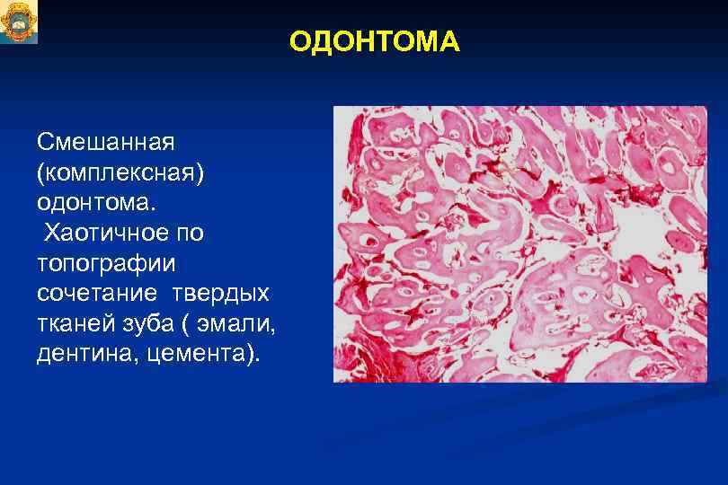 Одонтогенная киста фото