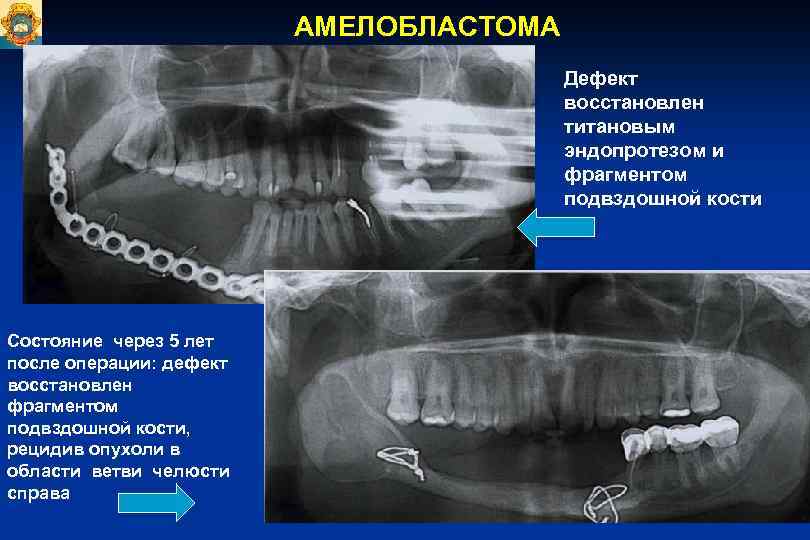 АМЕЛОБЛАСТОМА Дефект восстановлен титановым эндопротезом и фрагментом подвздошной кости Состояние через 5 лет после