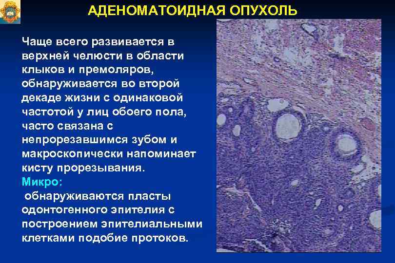 АДЕНОМАТОИДНАЯ ОПУХОЛЬ Чаще всего развивается в верхней челюсти в области клыков и премоляров, обнаруживается