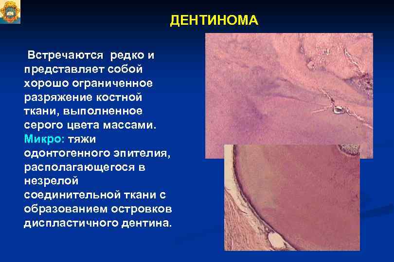 ДЕНТИНОМА Встречаются редко и представляет собой хорошо ограниченное разряжение костной ткани, выполненное серого цвета