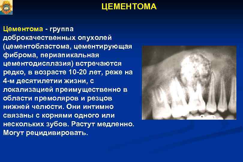 Доброкачественные одонтогенные опухоли презентация