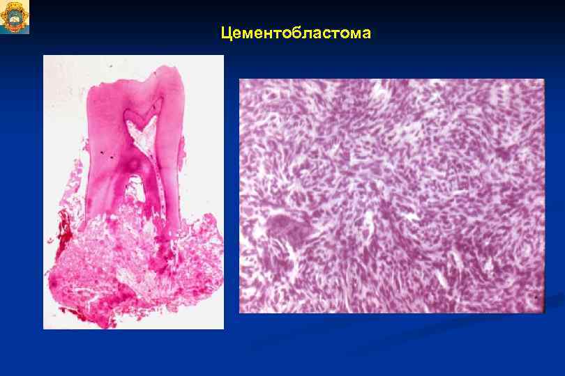 Цементобластома 