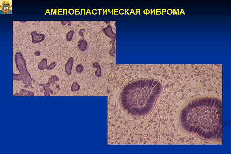 АМЕЛОБЛАСТИЧЕСКАЯ ФИБРОМА. 