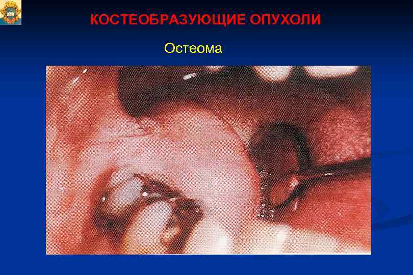КОСТЕОБРАЗУЮЩИЕ ОПУХОЛИ Остеома 