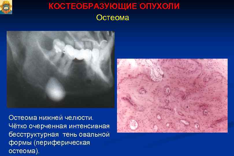 КОСТЕОБРАЗУЮЩИЕ ОПУХОЛИ Остеома нижней челюсти. Чётко очерченная интенсивная бесструктурная тень овальной формы (периферическая остеома).