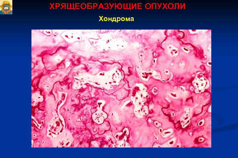 ХРЯЩЕОБРАЗУЮЩИЕ ОПУХОЛИ Хондрома 