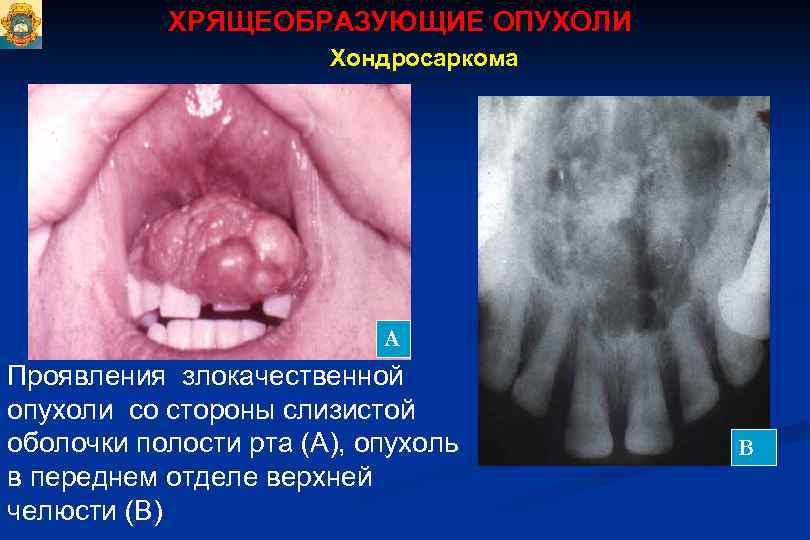 ХРЯЩЕОБРАЗУЮЩИЕ ОПУХОЛИ Хондросаркома А Проявления злокачественной опухоли со стороны слизистой оболочки полости рта (А),