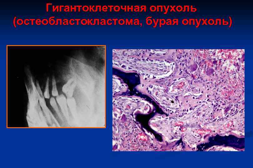 Гигантоклеточная опухоль (остеобластокластома, бурая опухоль) 