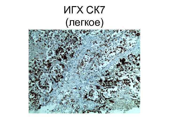 ИГХ СК 7 (легкое) 