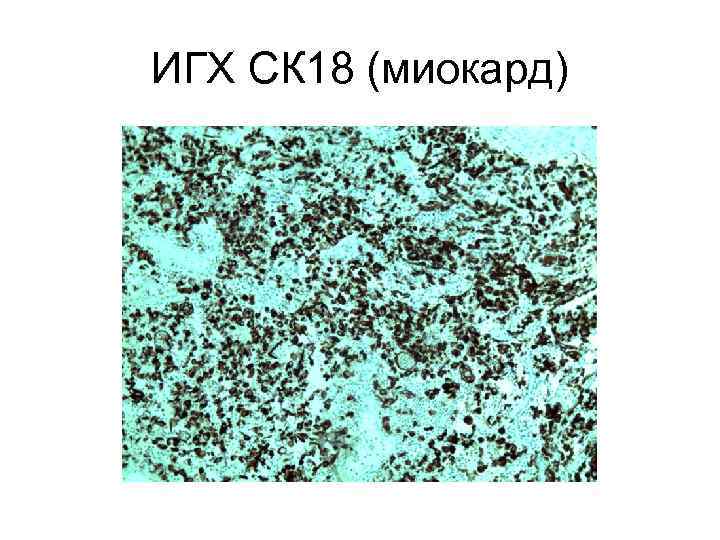 ИГХ СК 18 (миокард) 