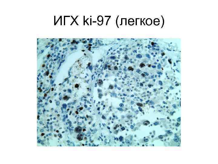 ИГХ ki-97 (легкое) 