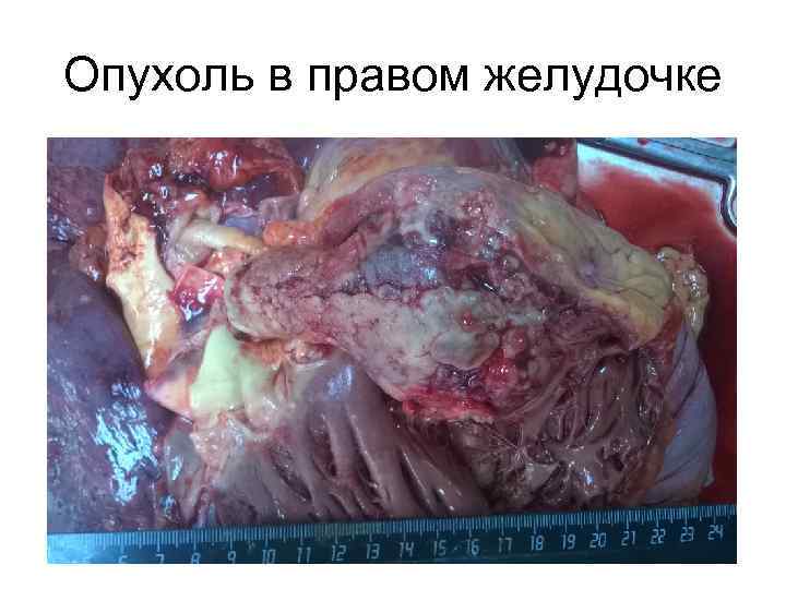 Опухоль в правом желудочке 