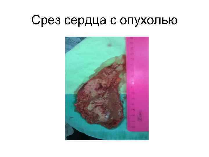 Срез сердца с опухолью 