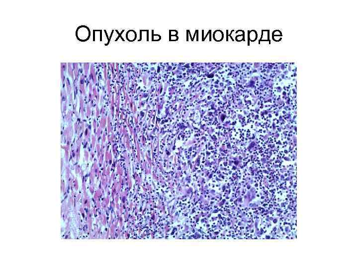 Опухоль в миокарде 