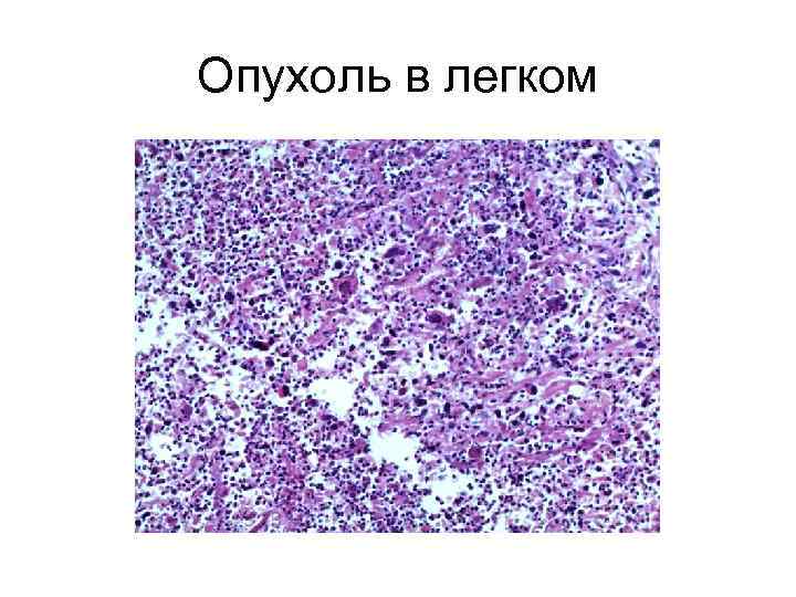 Опухоль в легком 