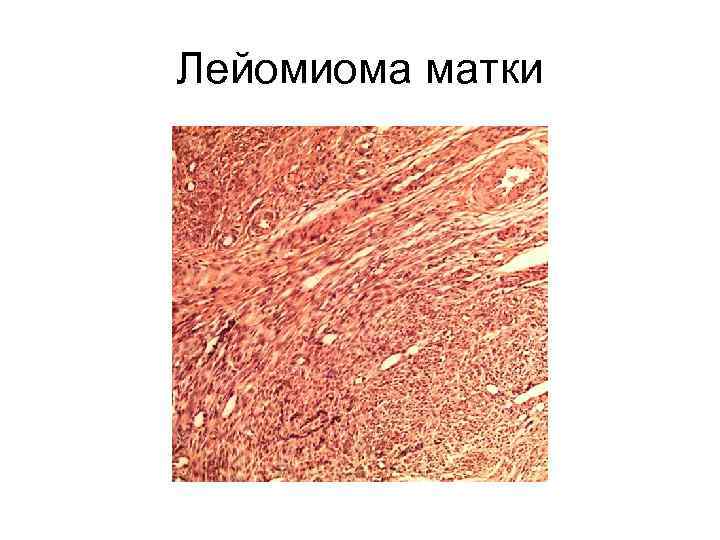 Лейомиома матки что это означает. Лейомиома матки патанатомия макропрепарат. Интрамуральная лейомиома матки гистология. Подслизистая лейомиома матки гистология что это такое. Лейомиома тела матки гистология.