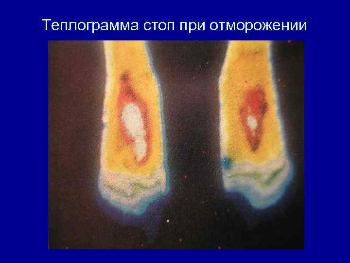 Теплограмма стоп при отморожении 