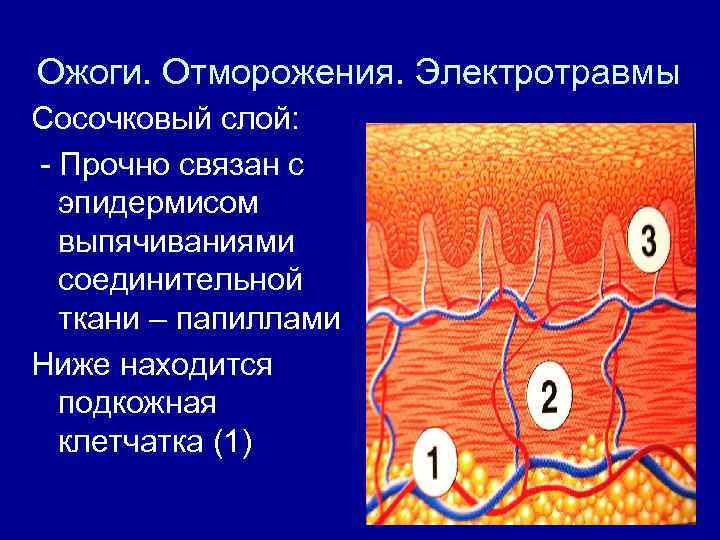 Ожоги. Отморожения. Электротравмы Сосочковый слой: - Прочно связан с эпидермисом выпячиваниями соединительной ткани –