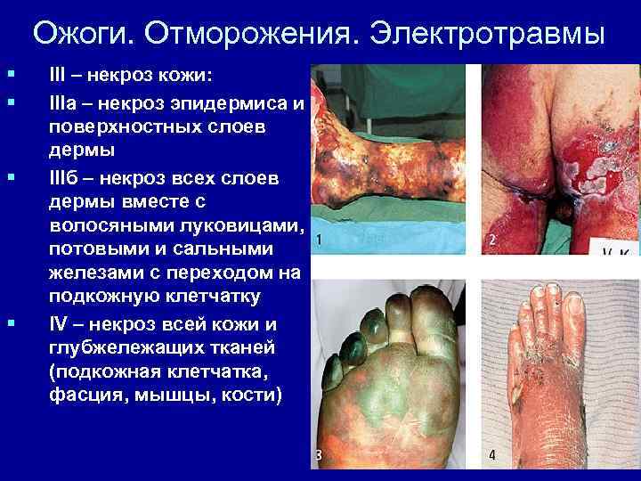 Ожоги. Отморожения. Электротравмы § § III – некроз кожи: IIIа – некроз эпидермиса и