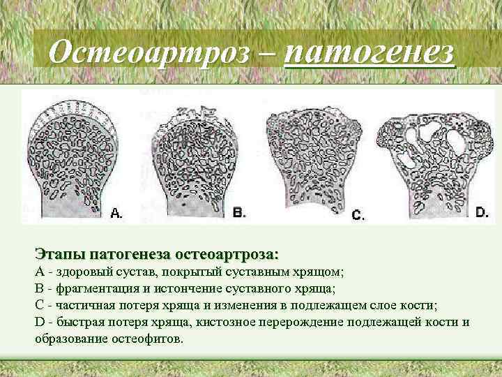 Остеоартроз – патогенез Этапы патогенеза остеоартроза: A - здоровый сустав, покрытый суставным хрящом; B