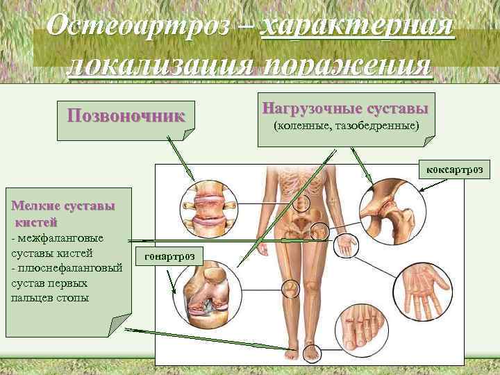 Остеоартроз – характерная локализация поражения Позвоночник Нагрузочные суставы (коленные, тазобедренные) коксартроз Мелкие суставы кистей