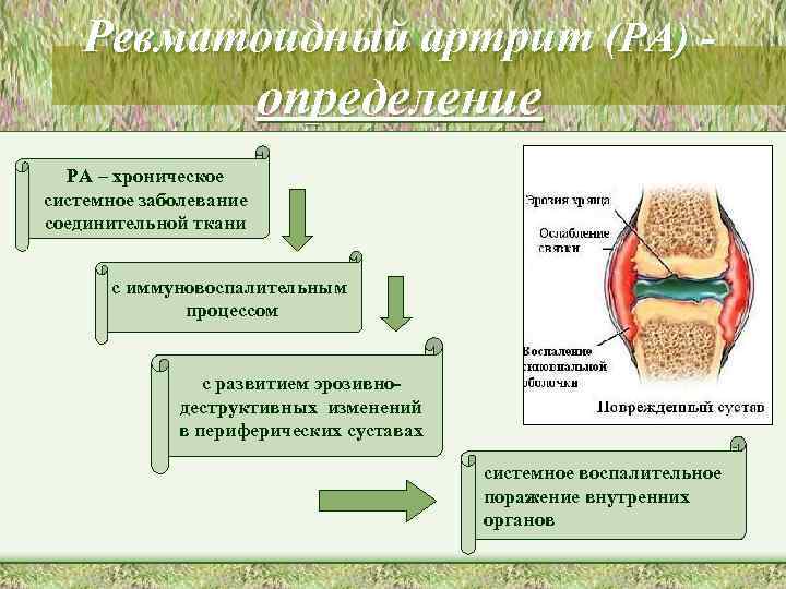 Ревматоидный артрит (РА) - определение РА – хроническое системное заболевание соединительной ткани с иммуновоспалительным