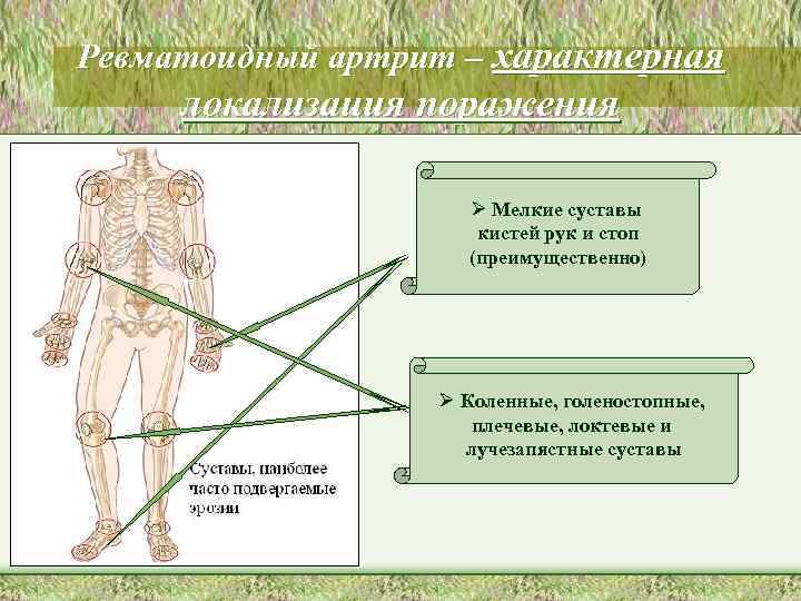 Ревматоидный артрит – характерная локализация поражения Ø Мелкие суставы кистей рук и стоп (преимущественно)