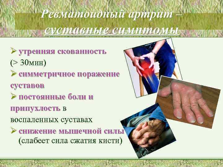 Ревматоидный артрит – суставные симптомы Ø утренняя скованность (> 30 мин) Ø симметричное поражение