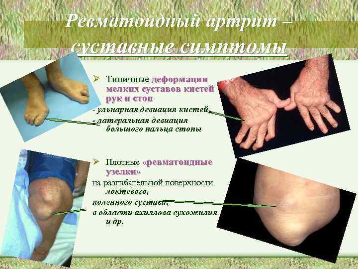 Ревматоидный артрит – суставные симптомы Ø Типичные деформации мелких суставов кистей рук и стоп