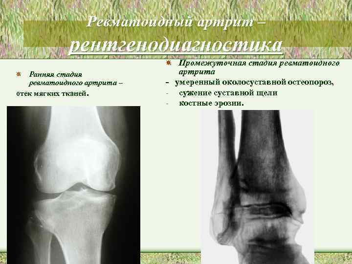 Ревматоидный артрит – рентгенодиагностика Ранняя стадия ревматоидного артрита – отек мягких тканей. Промежуточная стадия